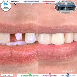 Newsfeed771-veneerCrown